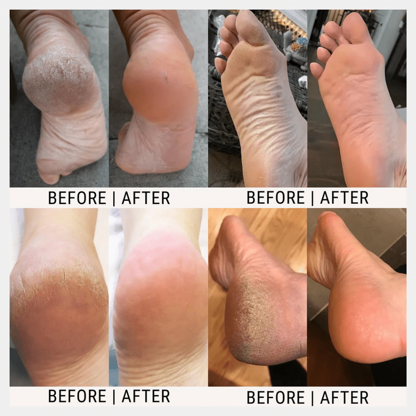 Luxrelivo™ Urea Foot Cream - Luxrelivo